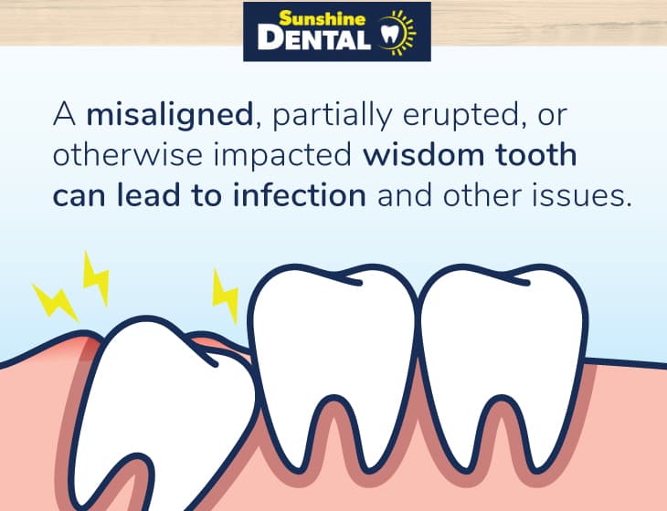 Diagram of an infected, misaligned, impacted wisdom tooth