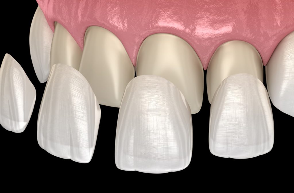 3d rendering of dental veneers being placed on top of teeth