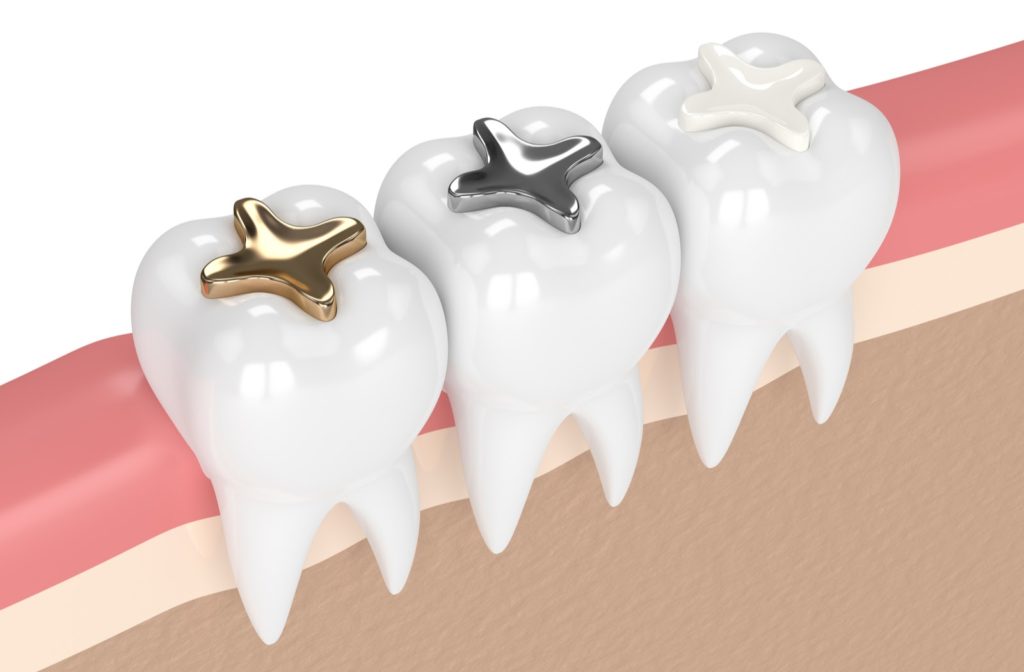 3d rendering of 3 different types of dental fillings