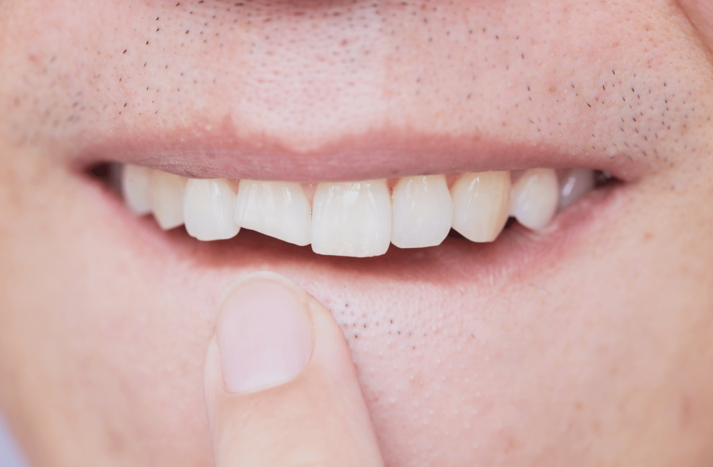 Person pointing at their chipped front tooth that is causing a toothache 