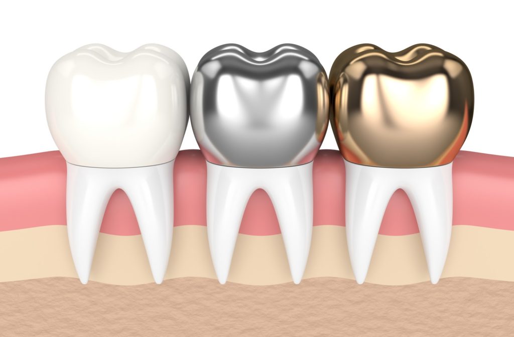 3D illustration of different types of dental crowns