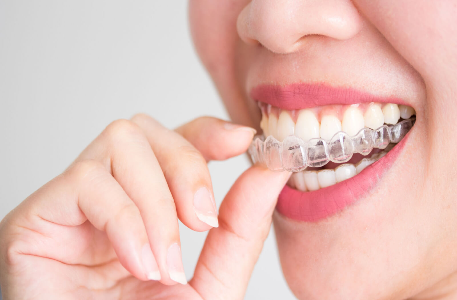 Can Invisalign Actually Fix An Overbite? - Impact Orthodontics