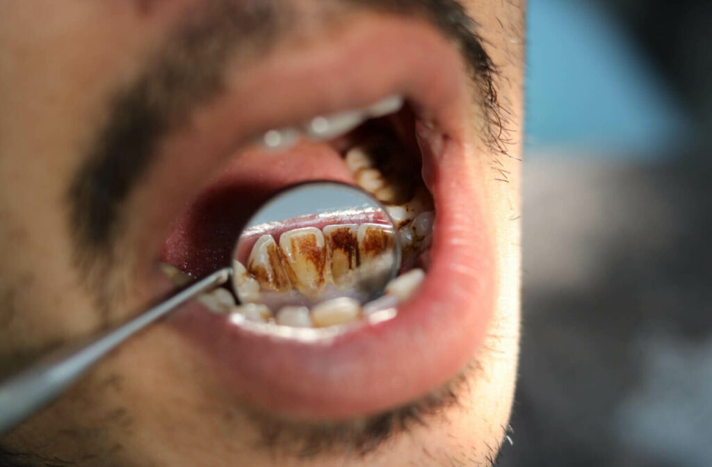 A close-up a young man's mouth  with  stain on the teeth cause by smoking