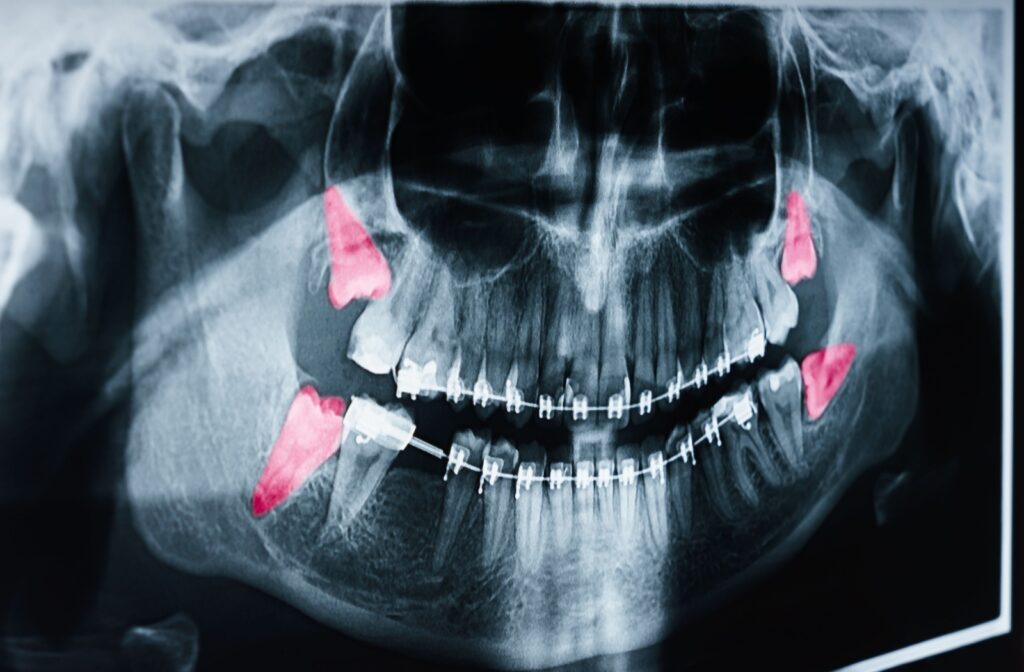 Panoramic dental x-ray highlighting all four wisdom teeth in red. The wisdom teeth appear impacted at different angles, with braces visible on the lower teeth.