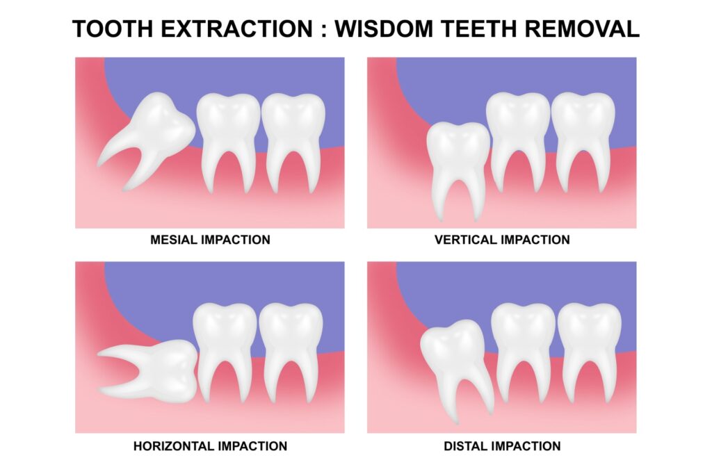 Illustration showing four types of wisdom tooth impaction: mesial impaction with the tooth angled forward, vertical impaction with the tooth aligned upright but blocked, horizontal impaction with the tooth lying sideways, and distal impaction with the tooth angled backward.